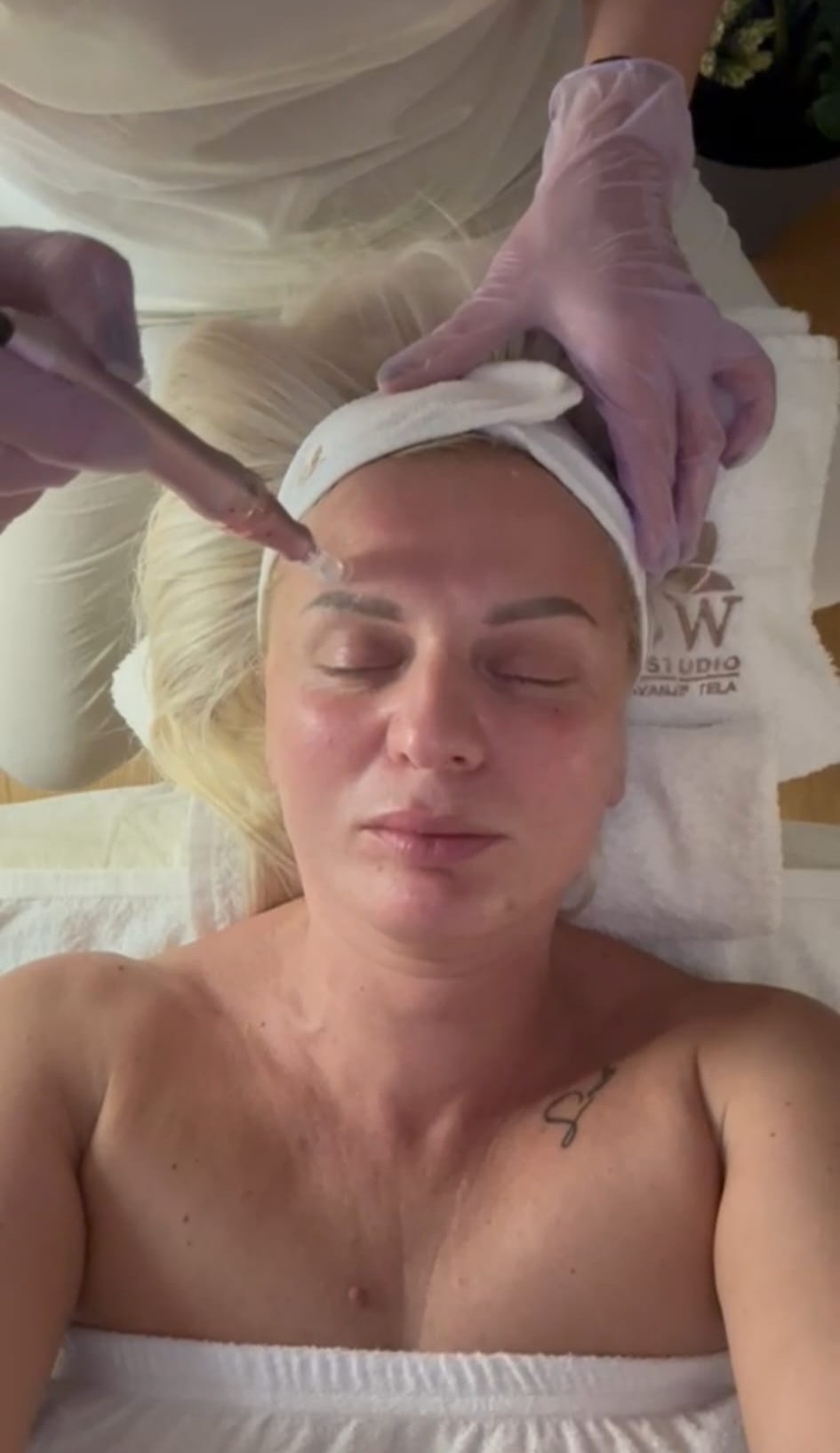 Kosmetičarka vodi Dermapen uređaj preko jagodične regije lica plave klijentkinje tokom microneedling tretmana.