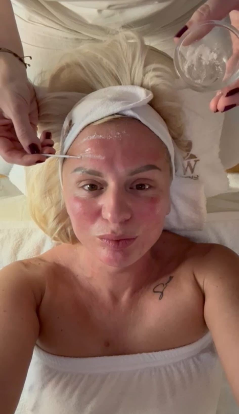 Klijentkinja opušteno leži dok joj se vrši tretman na čelu. Vidi se blago crvenilo (eritem), što je normalna pojava posle microneedlinga.